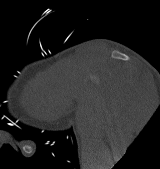 Anterior shoulder dislocation with Hill-Sachs and bony Bankart lesions (Radiopaedia 40424-42974 Sagittal bone window 14).png