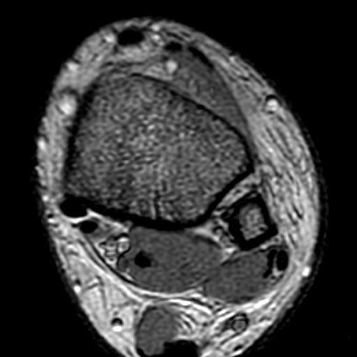 File:Anterior talofibular ligament rupture (Radiopaedia 15831-15484 Axial T2* 1).jpg