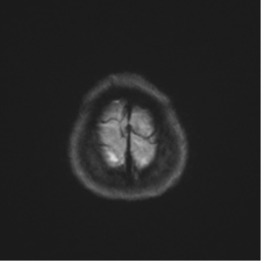 File:Anterior temporal lobe perivascular space (Radiopaedia 40946-43650 Axial DWI 54).png