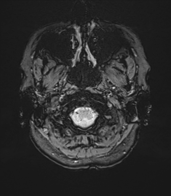 File:Anterior temporal lobe perivascular space (Radiopaedia 40946-43650 Axial SWI 5).png