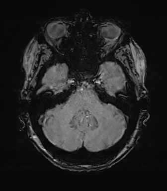 Anterior temporal pole cysts (Radiopaedia 46629-51102 Axial SWI 23).png