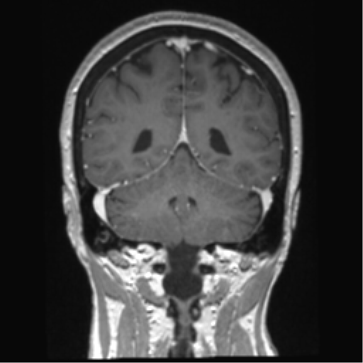 Anterior temporal pole cysts (Radiopaedia 46629-51102 Coronal T1 C+ 53).png