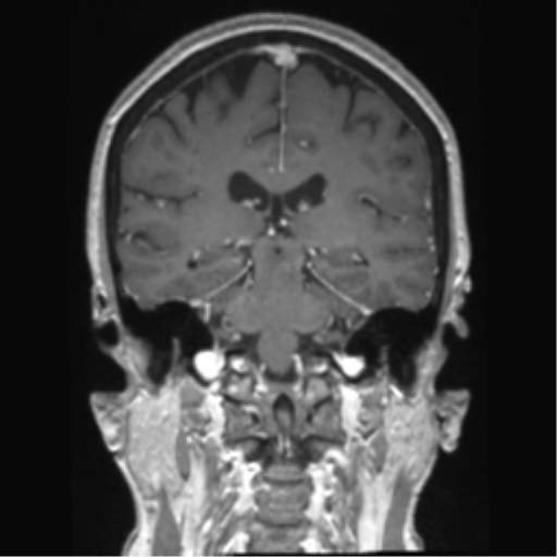Anterior temporal pole cysts (Radiopaedia 46629-51102 Coronal T1 C+ 73).png