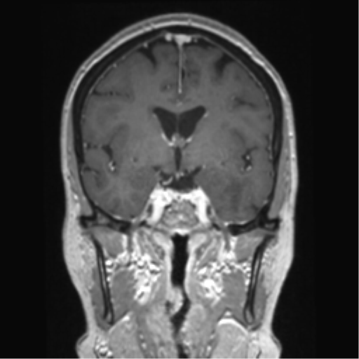 Anterior temporal pole cysts (Radiopaedia 46629-51102 Coronal T1 C+ 99).png