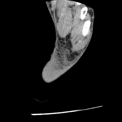 Anterior tibial artery false aneurysm (Radiopaedia 88984-105809 A 255).jpg