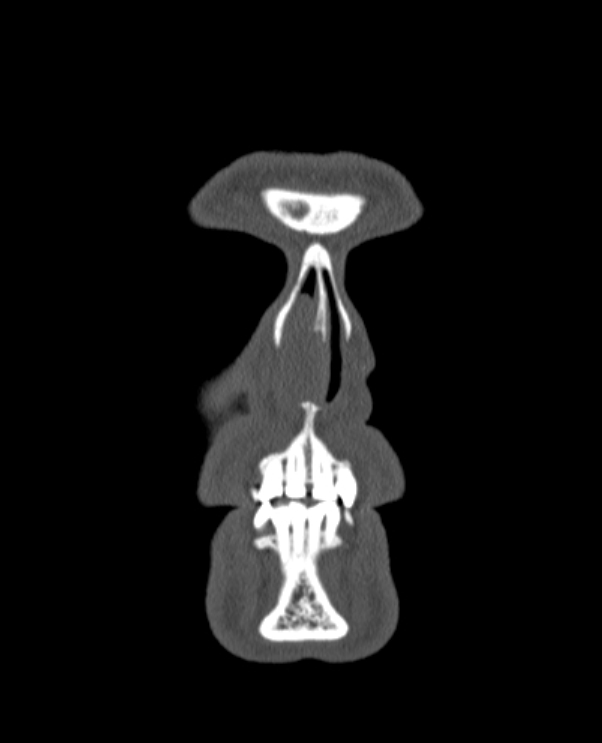 Antrochoanal polyp (Radiopaedia 79011-92169 Coronal bone window 86).jpg