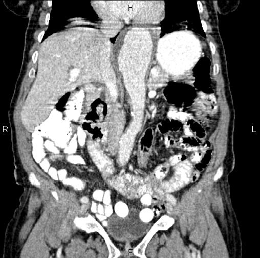 Aortic aneurysm and Lemmel syndrome (Radiopaedia 86499-102554 C 26).jpg