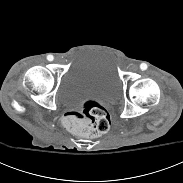 File:Aortic aneurysm with spinal destruction (Radiopaedia 42301-45410 A 105).jpg