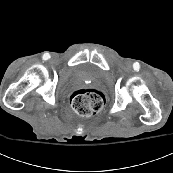 File:Aortic aneurysm with spinal destruction (Radiopaedia 42301-45410 A 113).jpg