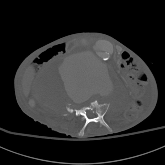 Aortic aneurysm with spinal destruction (Radiopaedia 42301-45410 Axial bone window 53).jpg