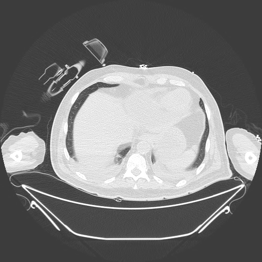Aortic arch aneurysm (Radiopaedia 84109-99365 Axial lung window 230).jpg