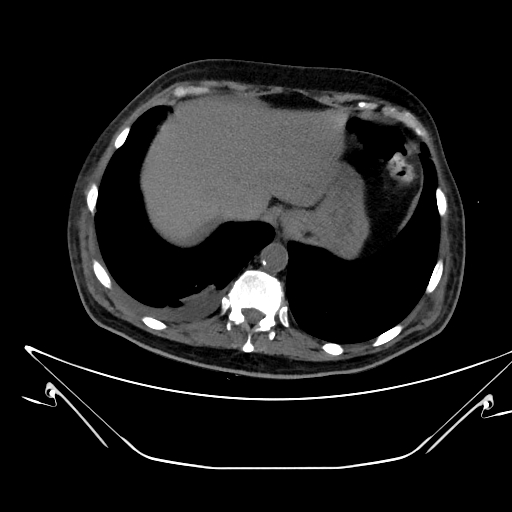 File:Aortic arch aneurysm (Radiopaedia 84109-99365 Axial non-contrast 243).jpg