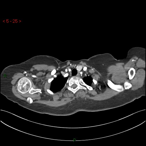 Aortic arch origin of left vertebral artery (Radiopaedia 51520-57286 A 24).jpg