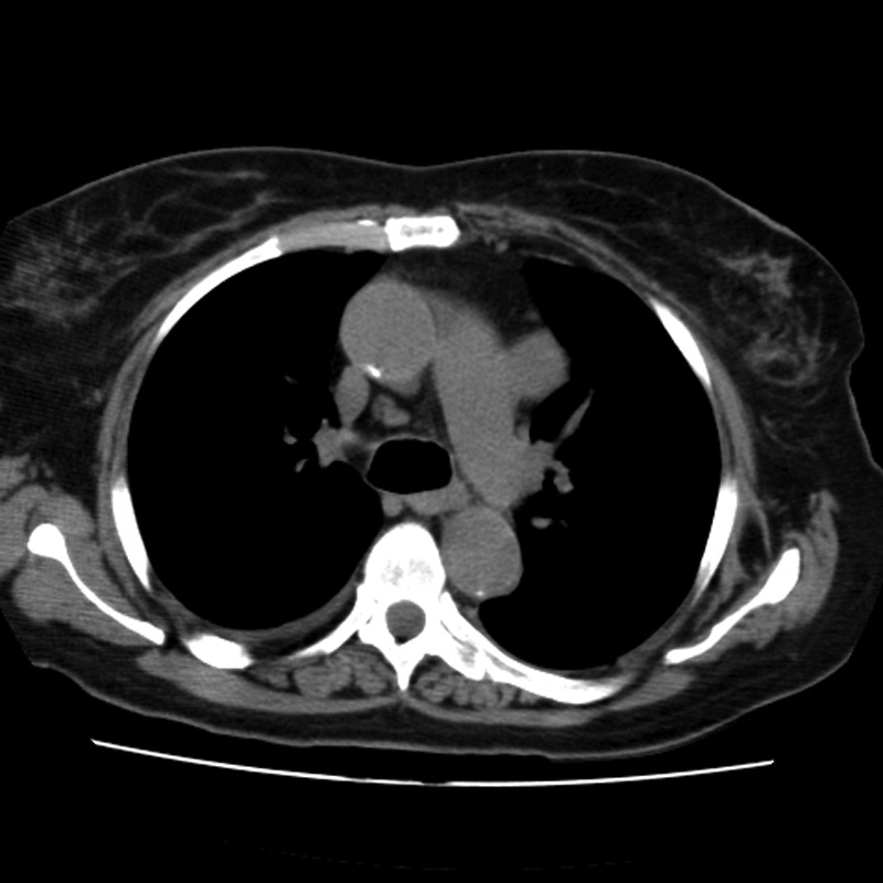 Aortic arch pseudoaneurysm (Radiopaedia 8534-9368 Axial non-contrast 28).jpg