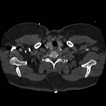 File:Aortic dissection (Radiopaedia 57969-64959 A 16).jpg