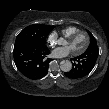 File:Aortic dissection (Radiopaedia 57969-64959 A 188).jpg
