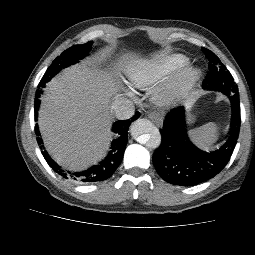File:Aortic dissection - Stanford A -DeBakey I (Radiopaedia 28339-28587 B 83).jpg