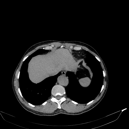 Aortic dissection - Stanford type A (Radiopaedia 83418-98500 Axial non-contrast 37).jpg