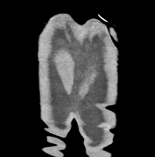 Aortic dissection - Stanford type B (Radiopaedia 50171-55512 B 86).png