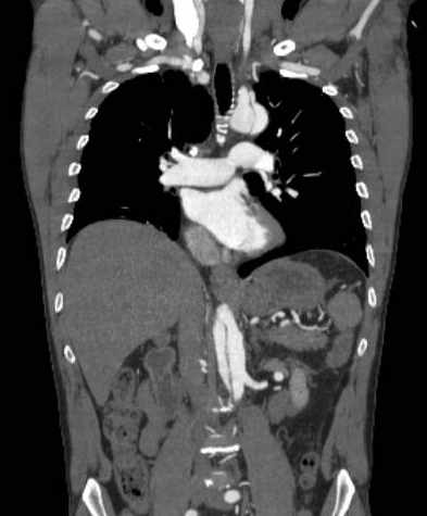 File:Aortic dissection - Stanford type B (Radiopaedia 73648-84437 B 61).jpg