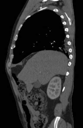 File:Aortic dissection - Stanford type B (Radiopaedia 73648-84437 C 118).jpg