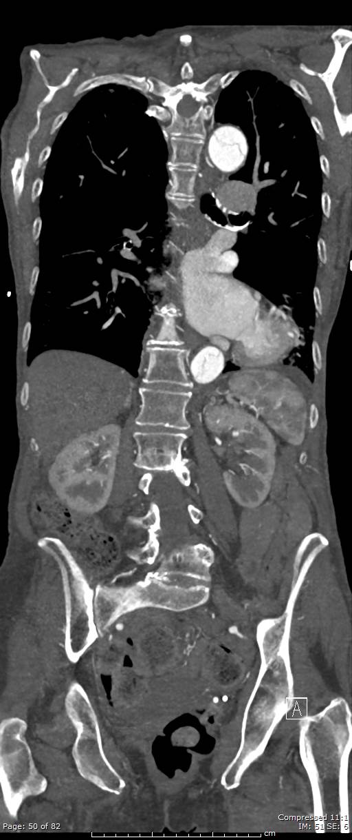 Aortic dissection with extension into aortic arch branches (Radiopaedia 64402-73204 A 50).jpg