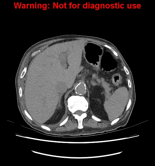 File:Aortic graft infection (Radiopaedia 44979-48907 Axial non-contrast 30).jpg