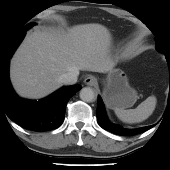 Aortic intramural hematoma (type B) (Radiopaedia 79323-92387 Axial C+ delayed 47).jpg