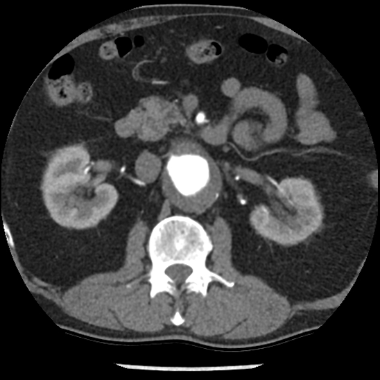 Aortic intramural hematoma (type B) (Radiopaedia 79323-92387 B 67).jpg