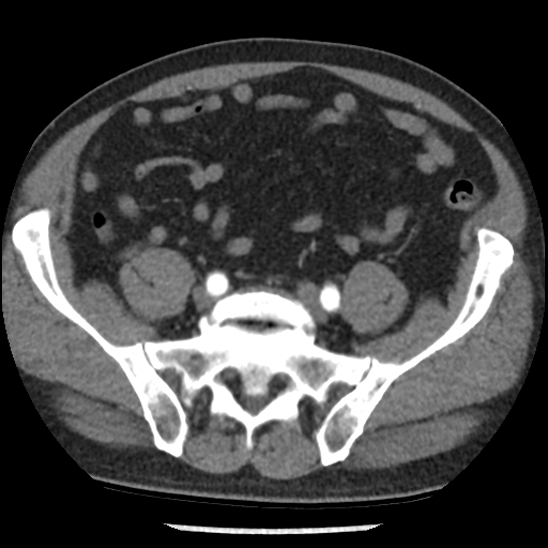 File:Aortic intramural hematoma (type B) (Radiopaedia 79323-92387 B 92).jpg