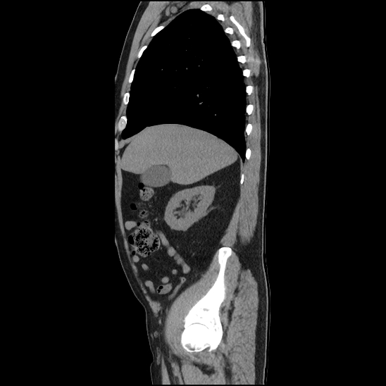 File:Aortic intramural hematoma (type B) (Radiopaedia 79323-92387 G 8).jpg