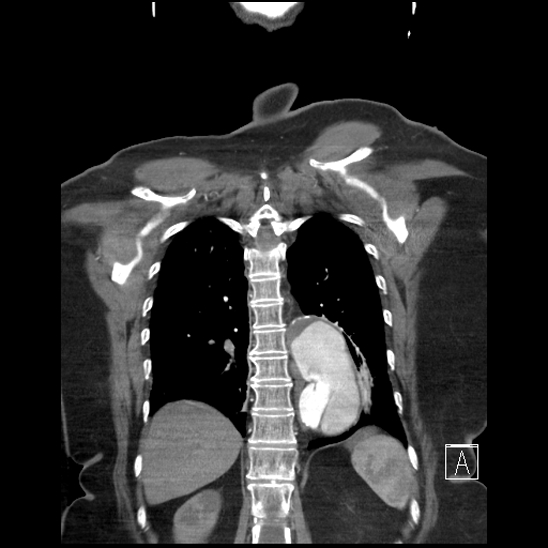Aortic intramural hematoma with dissection and intramural blood pool (Radiopaedia 77373-89491 C 51).jpg