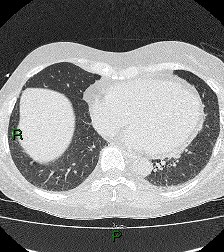 File:Aortic valve endocarditis (Radiopaedia 87209-103485 Axial lung window 70).jpg