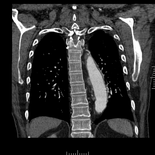 File:Aorto-coronary bypass graft aneurysms (Radiopaedia 40562-43157 B 35).png