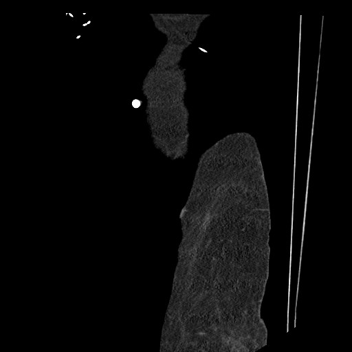 Aortocaval fistula (Radiopaedia 80280-93625 C 6).jpg