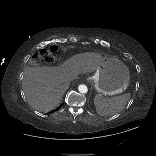 Aortoesophageal fistula with endovascular repair (Radiopaedia 73781-84592 Axial C+ CTPA 152).jpg