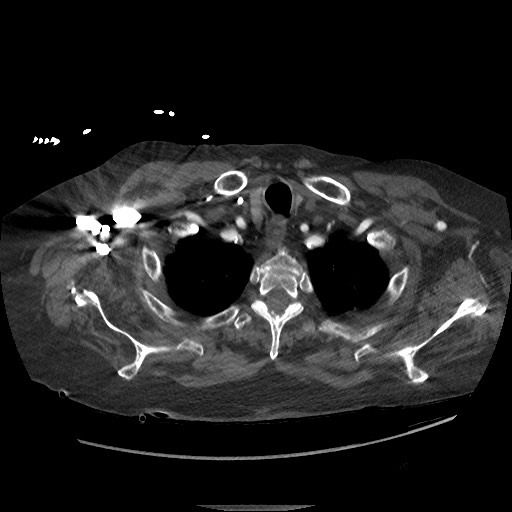 Aortoesophageal fistula with endovascular repair (Radiopaedia 73781-84592 Axial C+ CTPA 2).jpg