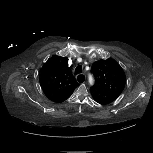 Aortoesophageal fistula with endovascular repair (Radiopaedia 73781-84592 Axial C+ CTPA 24).jpg