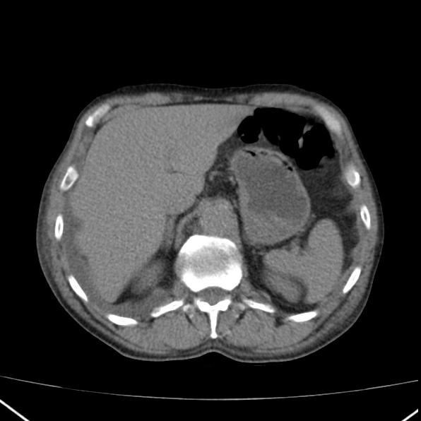 Aortoiliac occlusive disease (Radiopaedia 32134-33076 Axial non-contrast 11).jpg