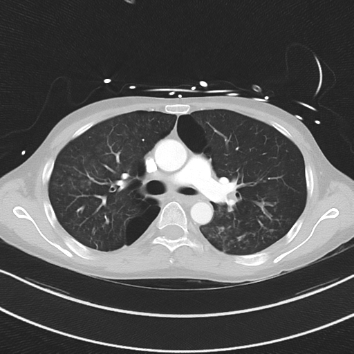 Apical bullous disease in a heavy smoker (Radiopaedia 33067-34092 Axial lung window 26).png