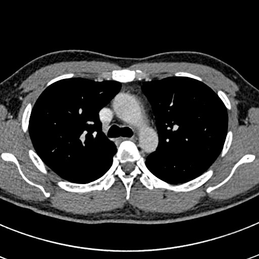 File:Apical lung mass mimic - neurogenic tumor (Radiopaedia 59918-67521 A 29).jpg