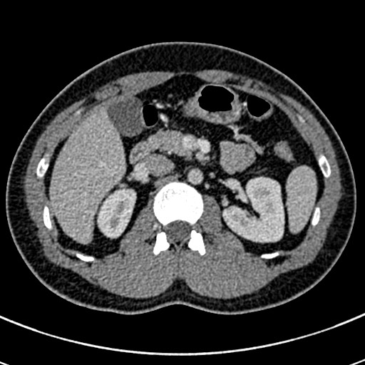 Apical lung mass mimic - neurogenic tumor (Radiopaedia 59918-67521 A 94).jpg