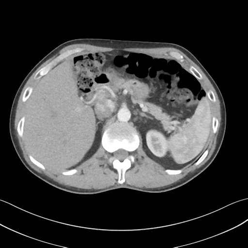 File:Apical pleural calcification (Radiopaedia 46141-50499 Axial C+ delayed 73).png