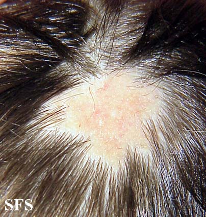 Aplasia Cutis Congenita (Dermatology Atlas 2).jpg