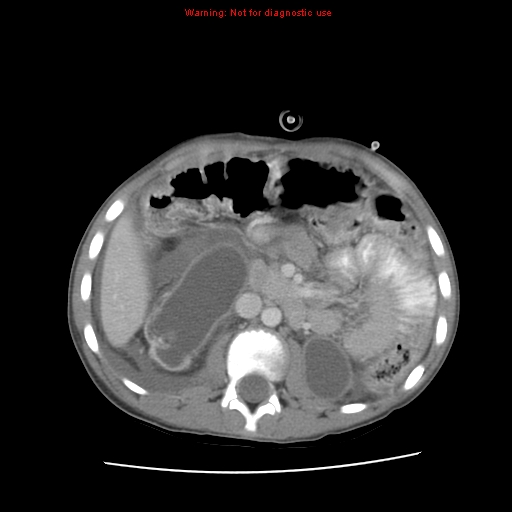 File:Appendicitis with phlegmon (Radiopaedia 9358-10046 A 31).jpg