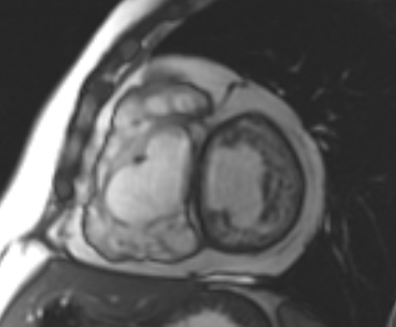 File:Arrhythmogenic right ventricular cardiomyopathy (Radiopaedia 69431-79307 Short axis cine 139).jpg