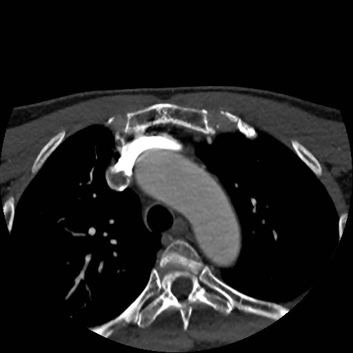 Artery of Percheron infarct (Radiopaedia 48088-52894 A 2).jpg
