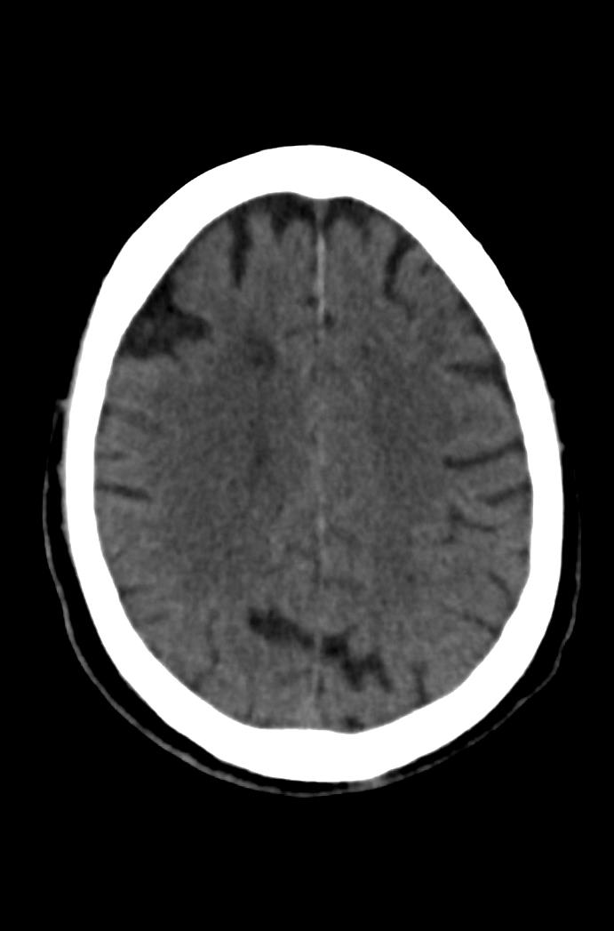 Artery of Percheron infarction (Radiopaedia 80613-94202 Axial non-contrast 134).jpg