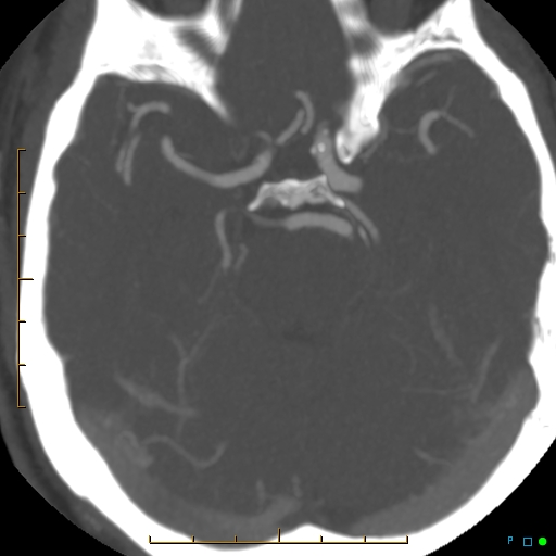 File:Artifactual basilar artery stenosis due to metallic stent (Radiopaedia 31206-31923 A 16).jpg
