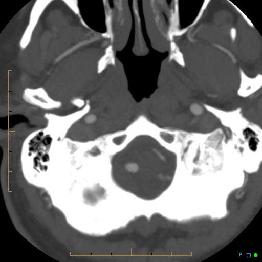File:Artifactual basilar artery stenosis due to metallic stent (Radiopaedia 31206-31923 A 4).jpg